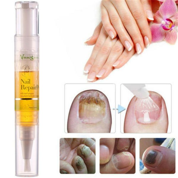 

Nail repair nail treatment liquid pen anti fungal onychomyco i removal e ence
