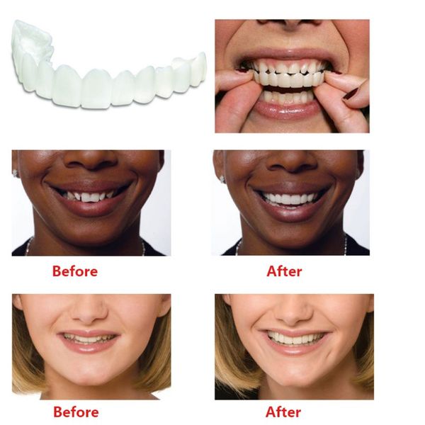 

Tooth Orthodontic Braces Orthodontic Dental Appliance Trainer Alignment Braces for Teeth Straight Alignment Free Shipping