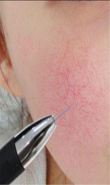 

portable vascular removal machine high frequency needles anti redness blood vessel therapy spider veins removal beauty equipment8252587