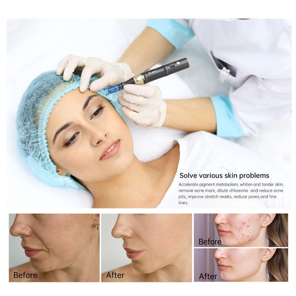 

dr.pen a8s electric microneedling derma pen microneedling relief dark sore nutrition input