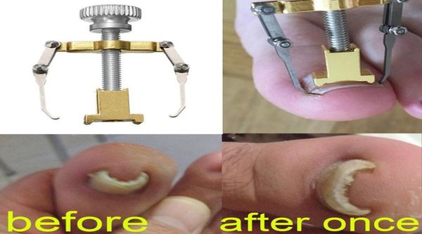 

ingrown toenail corrector toe pedicure foot nail care tools stainless steel pedicure treatment onyxis bunion correction tool9168587