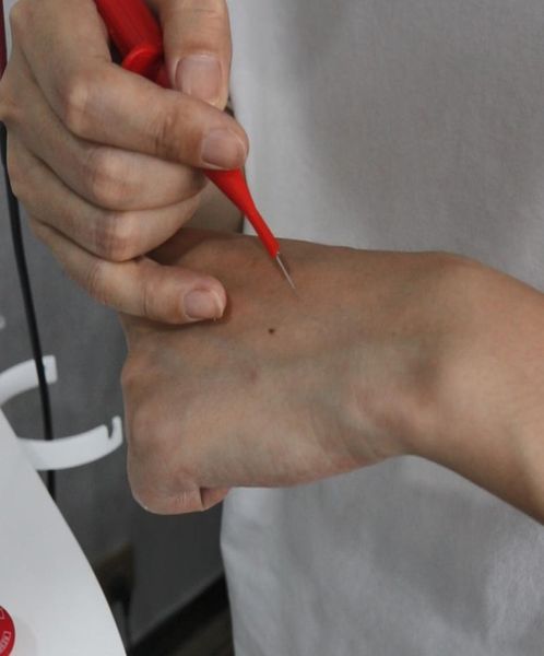 

needles for rbs facial and body vascular removal machine use4373413, Black