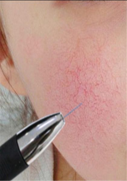 

portable vascular removal machine high frequency needles anti redness blood vessel therapy spider veins removal beauty equipment7850984