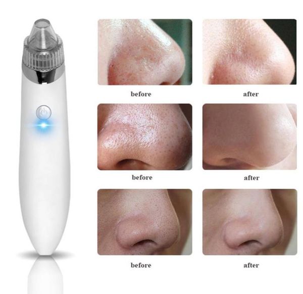 

electric usb charge vacuum blackhead removal acne blemish remover device blackhead extractor nose blackhead cleaner tool4621695