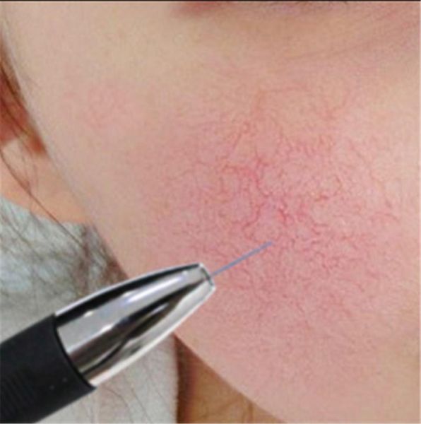

portable vascular removal machine high frequency needles anti redness blood vessel therapy spider veins removal beauty equipment2990198