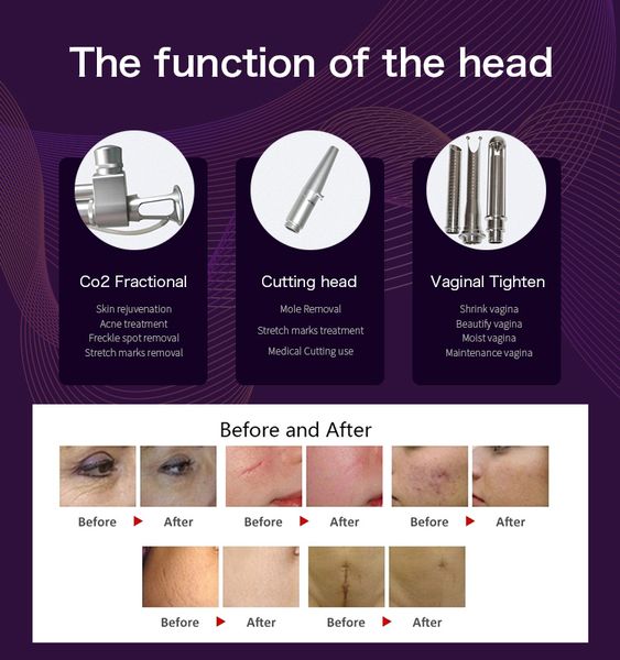 

co2 rf laser marking machine fractional stretch marks removal beauty machine 10600nm sensor treatment before and after agent price, Black