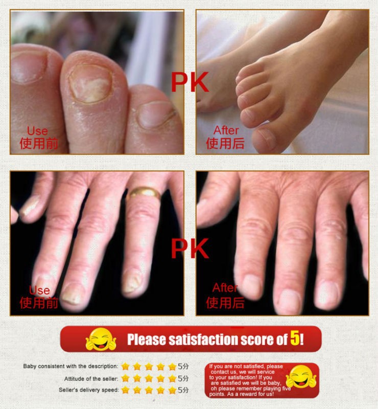 2015 snazii fungal nail treatment essence nail and foot whitening toe 2015 SnazII Fungal Nail Treatment Essence Nail And Foot Whitening Toe