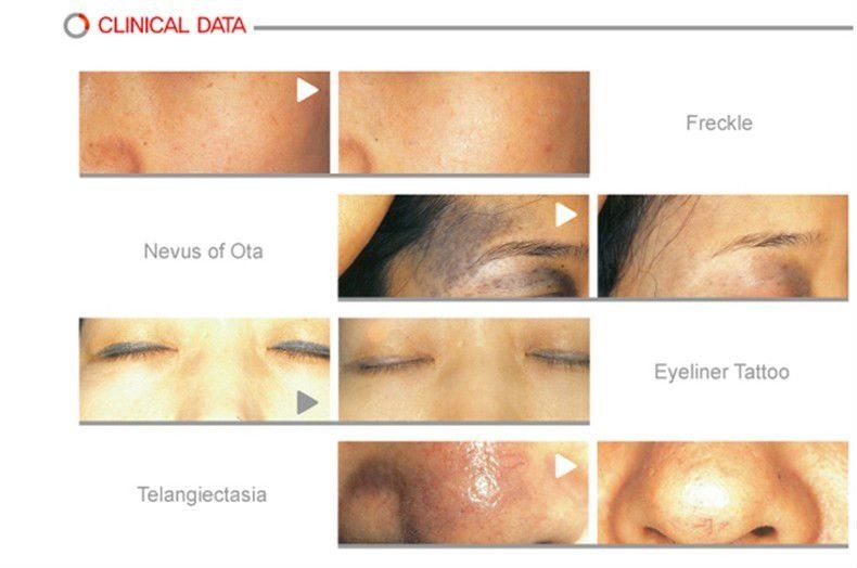 The Effects of UV Exposure on Ageing - Silhouette Spa and ... Nd Yag Laser Tattoo Removal For Skin Whiten Acne Removal ...