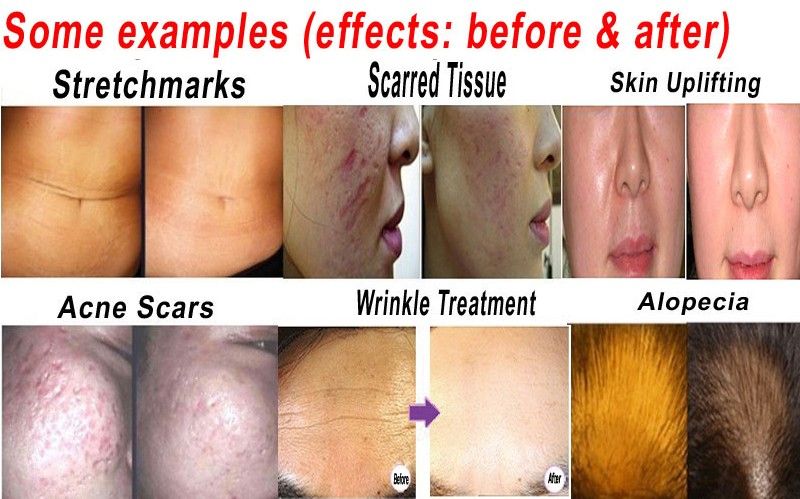 1200 Needles Derma Roller With Interchangeable Head Drs Dermaroller Cellulite And Stretch Marks Anti Hair Loss Treatment Microneedle Skin Nurse System Needling Wrinkles From Youmvp 6 52 Dhgate Com