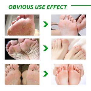 Aloe Vera Foot Mask Peleling pour les jambes Pieds Masque Exfoliant Scoth Scotr