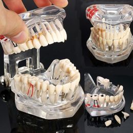 Modèle de dents d'implant dentaire, Arts et artisanat, avec pont de restauration, dentiste pour l'enseignement des sciences, étude 1251H