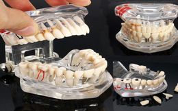 Kunst en ambachten tandheelkundig implantaat tanden model met restauratie brugtand tandarts voor wetenschapsonderwijsstudie16798180