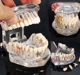 Kunst en ambachten tandheelkundig implantaat tandenmodel met restauratie brugtand tandarts voor wetenschap onderwijstudie16253034