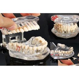 Modèle de dents de maladie d'implant dentaire d'arts et d'artisanat avec le dentiste de dent de pont de restauration pour l'étude d'enseignement des sciences 13594528 Drop Del Dh9Nr