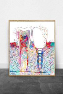 Imagen de arte dental Implante dental Impresión en lienzo Dentista Arte de la pared Pintura Medicina Higienista Póster Diente Acuarela Clínica Decoración 4294739