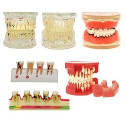 Tandheelkundige floss pathologische typodont tanden model parodonticsimplantendodontische cariës tandheelkundig 230421