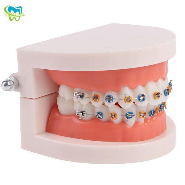 Modèle dentaire de dents de dents dentaire avec des accolades de support métallique