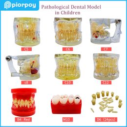 Tandheelkundige pathologische typodont tanden schimmel parodontie endodontische cariës kinderen tandheelkunde leren student studeren tandenmodel