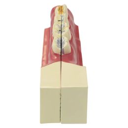 Tandheelkundig onderwijsmodel Reparatie Pathologisch getroffen tandmodel Pulp voor tandartsonderwijs en training Dental Magnet Dentistry