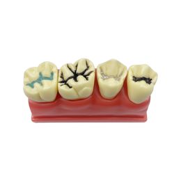 Tandtanden Model 4 keer pit- en spleetafdichtingsmodel Pathologische modellen voor tandheelkundige technicus lesgeven studeren