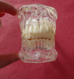 Modèle de pathologie dentaire des dents avec demi-implant montre clairement la forme d'origine et toute la structure3144381