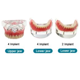 Modèle de dentiste de dents de dents de dents avec implant Retirez le modèle de démonstration de prothèse de pont