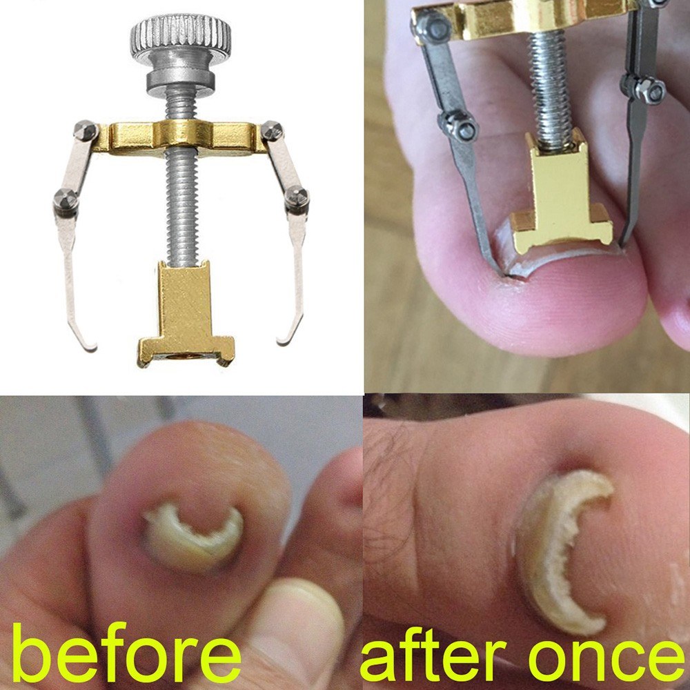 

Ingrown Toenail Corrector Toe Pedicure Foot Nail Care Tools Stainless Steel Pedicure Treatment Onyxis Bunion Correction Tool