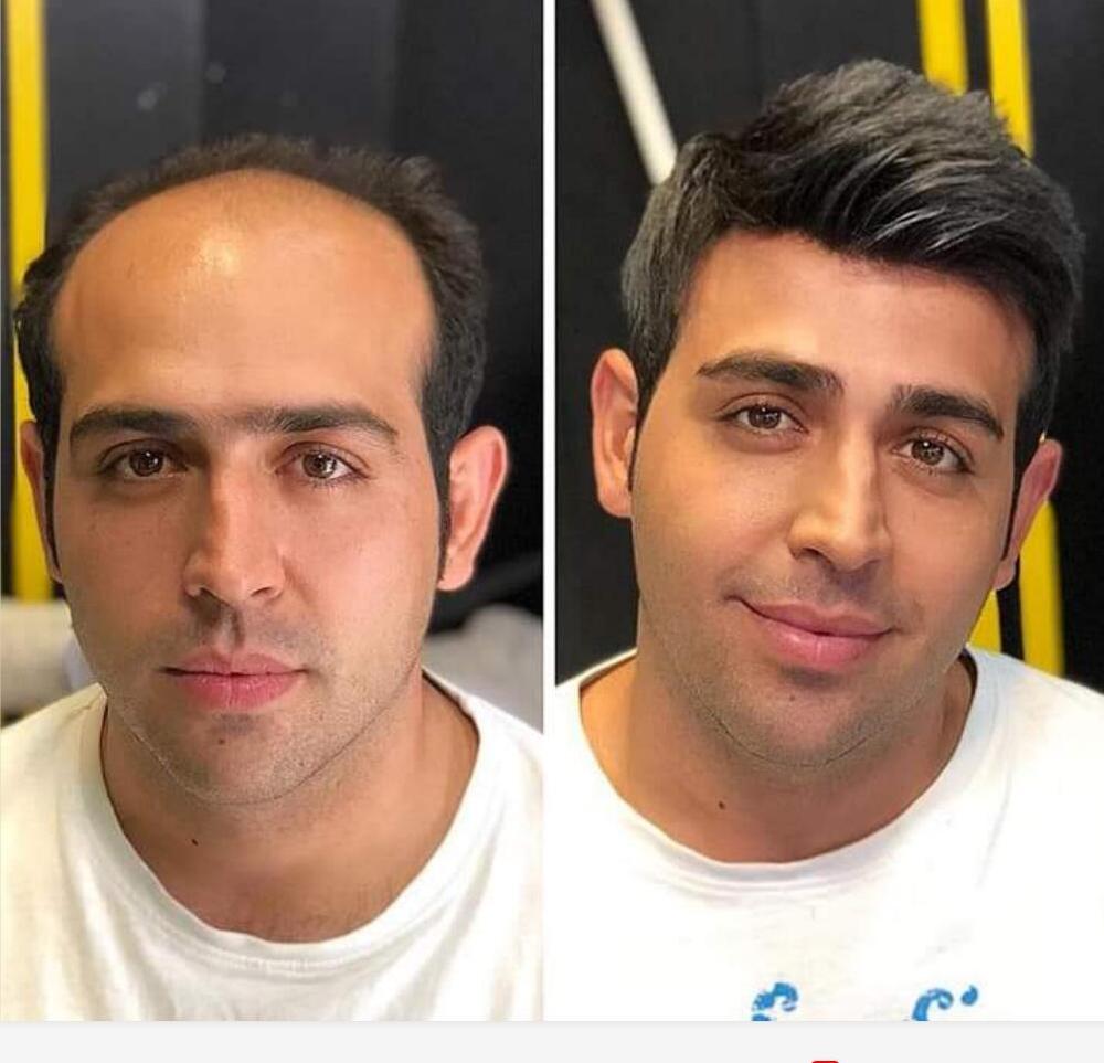 

Lace Front Human Hair Toupee Replacement Dark Brown Mono Toupee for Men 100% Human Hair System, Black