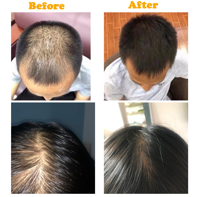 30ml Hair Growth Products Fast Growing Hair Oil Hair Loss Care Spray Beauty & Scalp Treatment for Men WomenScouts-image-732169012