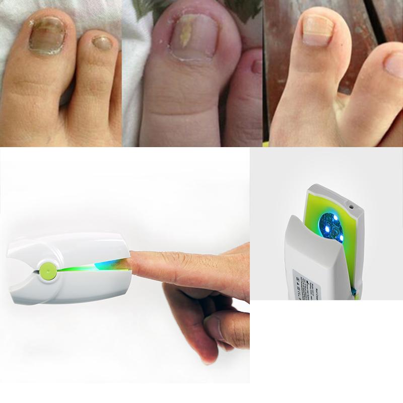 

Powerful Effective Nail Cleaner Therapy Treatment Rechargeable Nail Fungus Laser Device Cure Fungus Home Use