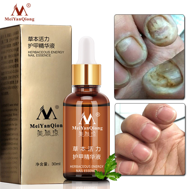 

MeiYanQiong Nail Treatment Repair Essence Anti Fungus Herbal Serum Onychomycosis Paronychia Product Removal Infection Nail Care