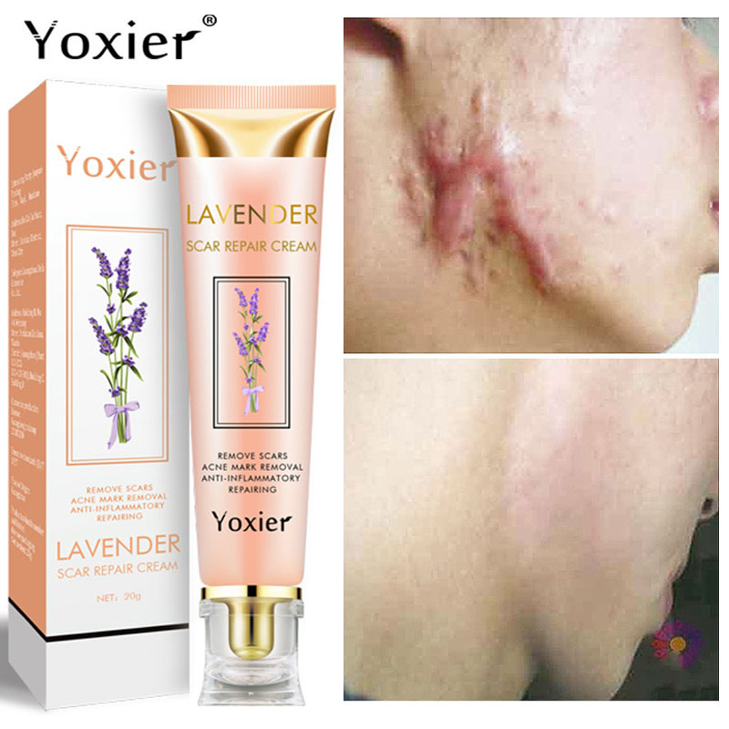 

Yoxier Lavender Scar Repair Cream Acne Scar Removal Pigmentation Corrector Remove Stretch Marks Smooth Skin Whitening Scar Care