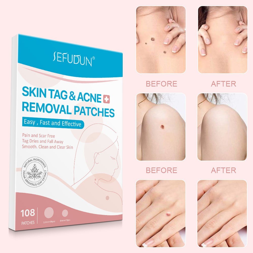 

108pcs Acne Skin Tag Remover Patches Acne Blemish Remover Pimple Absorbing Cover Anti-Infection Invisible Hydrocolloid Treatment Skin Care, Customize