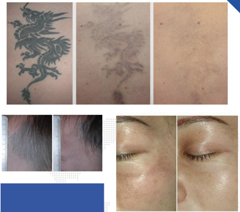 

Q Switched Nd Yag Laser Tattoo Removal Machine 532nm 1064nm 1320nm 755nm Picosecond Lazer Pigment Speckle Remove System, Black