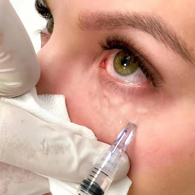 

Fillmed Mesotherapy Crystal 3 Pins Mesotherapy Needle 3 Pin Meso Nanosoft Microneedles