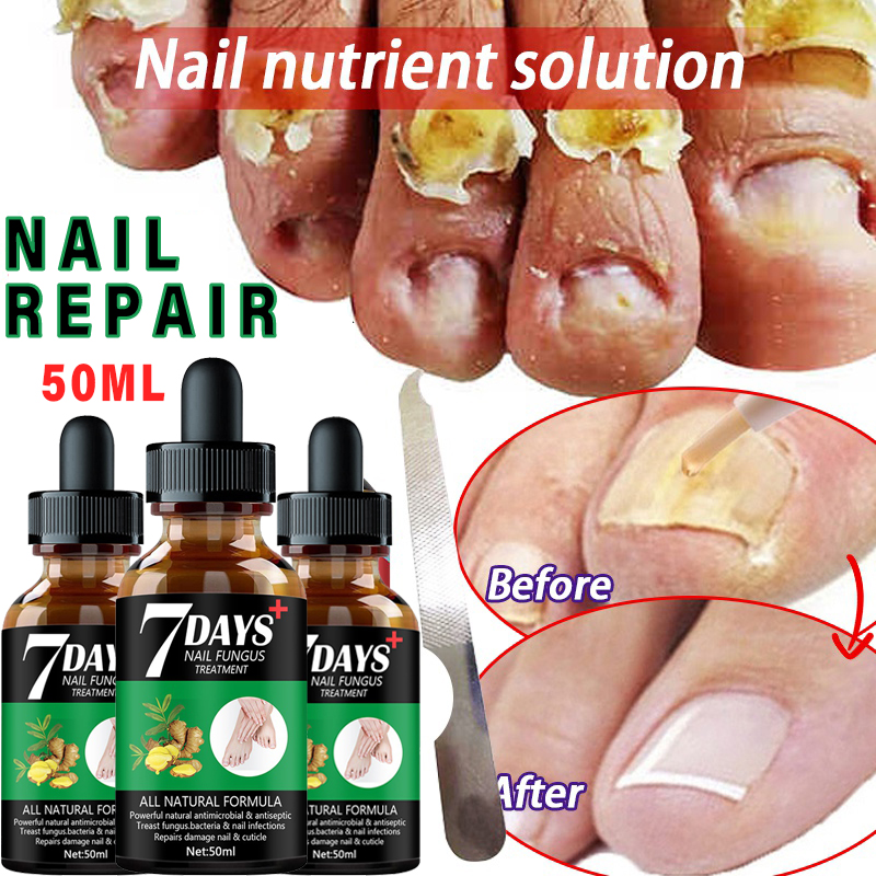 

Accessories 2022 New Nail Fungus Treatment Essence Serum Care Hand and Foot Care Removal Repair Gel Anti-infective Paronychia Onychomycosis