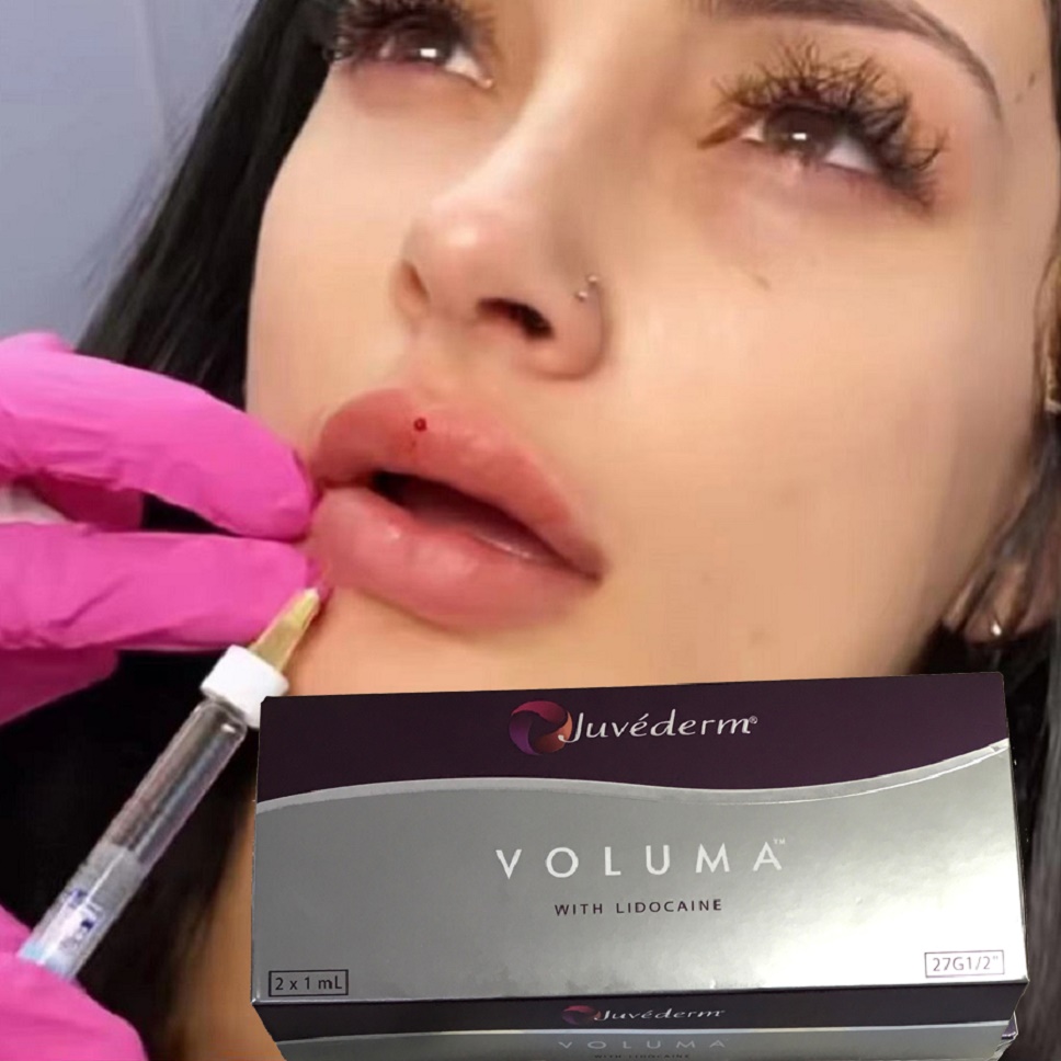 

Beauty Items Juvaderm Voluma Injectable Dermal Filler Hyaluronics Acids cross linked Reshape Facial Contour