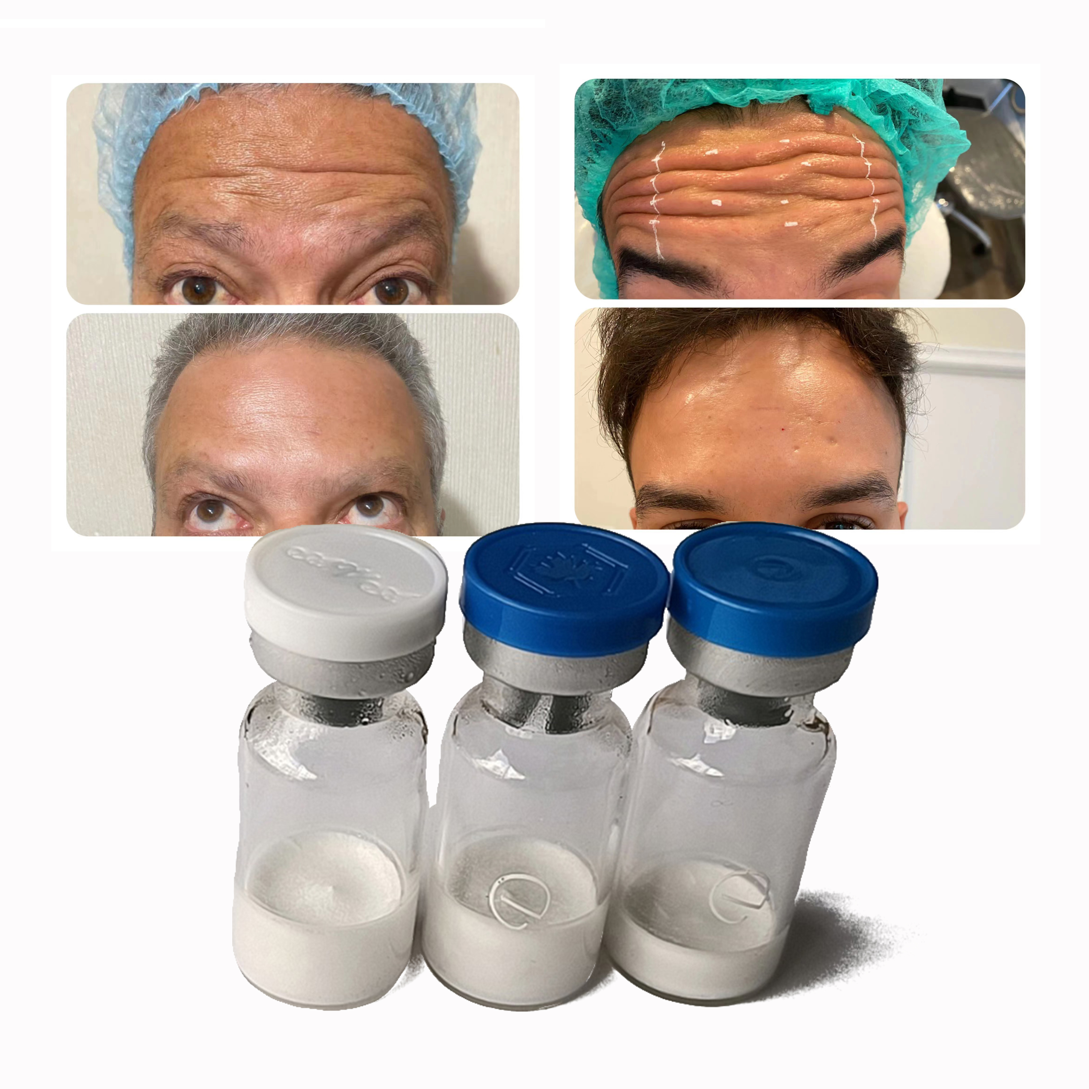

Anti wrinkle Israderm botax injection 100 u inject facial Private label Near Me