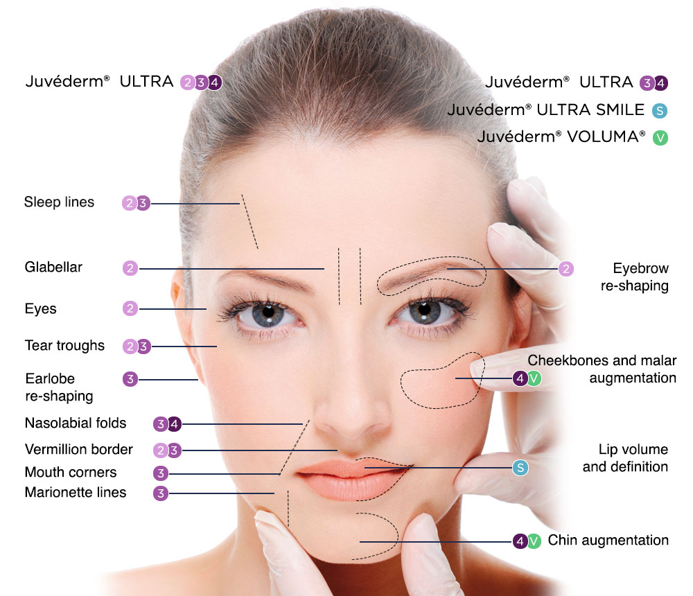 Beauty Items wholesell Buy Juvederms 2*1ml Ultra 3 Ultra 4 voluma Dermal Filler Gel-image-760614577