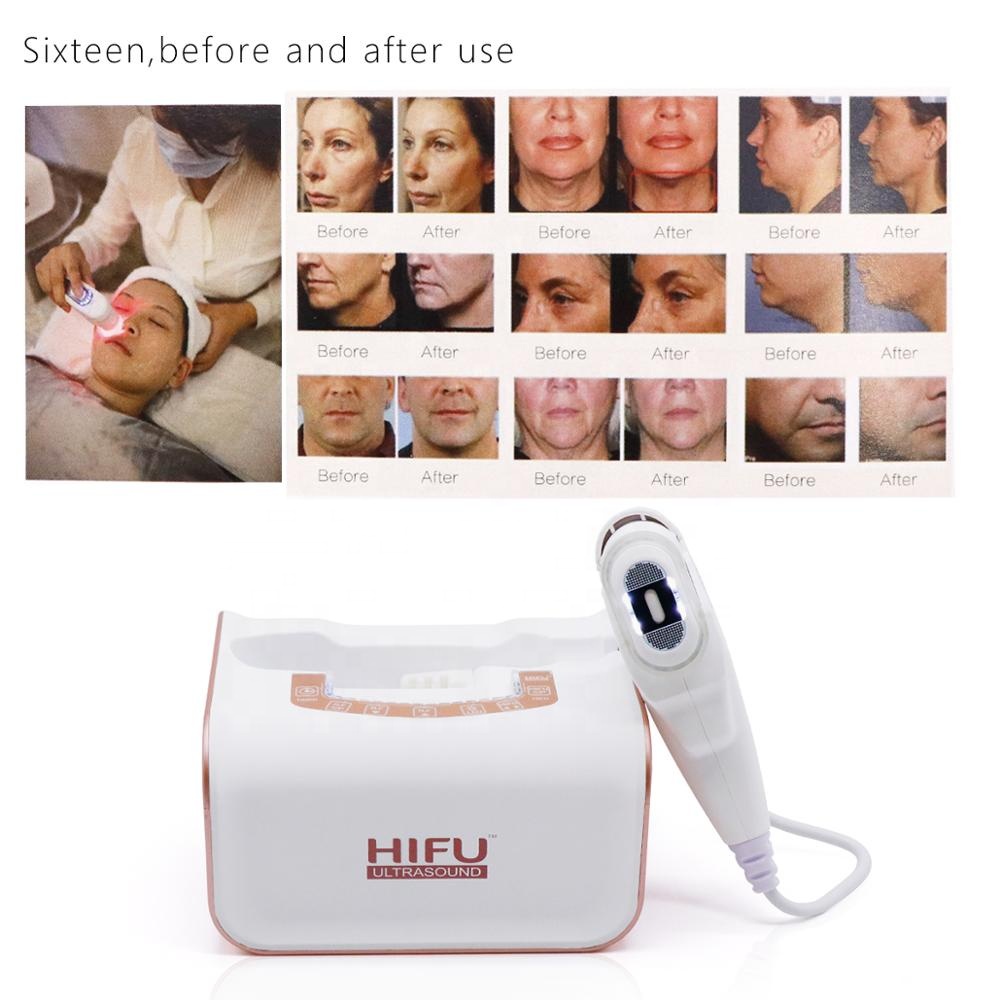 Portable 2 In 1 Hifu Machine Home Use Face Lifting Wrinkle Removal Eyes Bag Removal High Intensity Focused Ultrasound Facial Machine