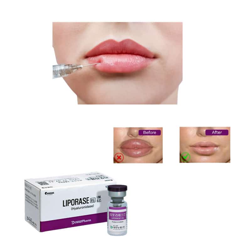 

Liporase Beauty Items1500u*10vials of Hyaluronidases Dissolves Hyaluronsy Solution dissolving HAs Dermal Fill