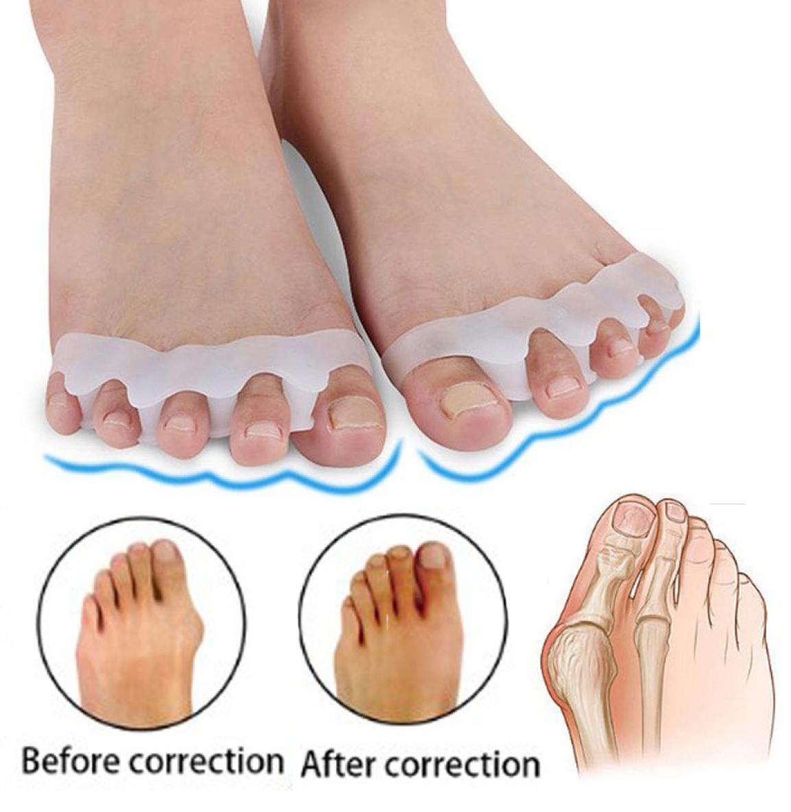 

Hallux Valgus Braces Toe Separator Overlapping Toes Rehabilitation Treatment Foot Bone Ortic Device Feet Care Silicone Gel Buni3268228