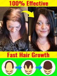 Aceite de crecimiento del cabello, repara efectivamente la calvicie, la pérdida de cabello hereditaria, la pérdida de cabello posparto y repara la línea del cabello