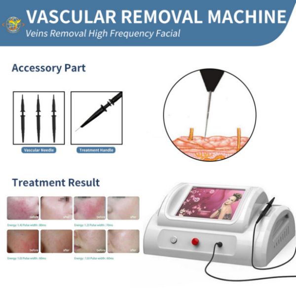 Máquina láser RF de alta frecuencia para eliminación Vascular, tratamiento de venas varicosas, eliminación de vasos sanguíneos, venas de araña, Remove324