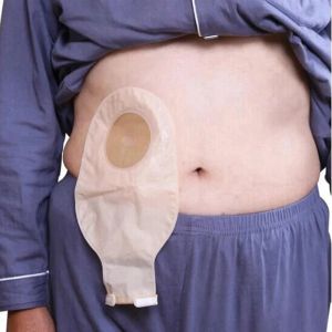 Ostomiezakken 30-delige afvoerbare zakjes voor colostomie ileostomie stoma zorg 20-60 mm economische afvoerklep colostomie zakken