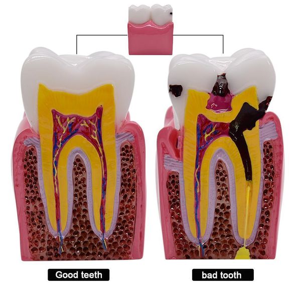 Autre hygiène buccale 1 pc 6 fois modèles de comparaison de caries dentaires modèle de carie dentaire pour l'étude dentaire enseignement de l'anatomie dentaire modèle de dents 230617
