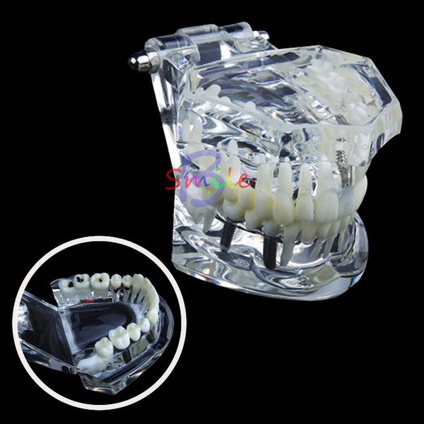 Otro estudio oral de higiene oral 1 PPCS Dental Study Tooth Transparente Modelo de dientes patológicos para adultos Equipo de laboratorio dental DentistTeciding Instrumento Herramienta 230815