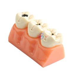 Andere orale hygiëne 1 -sten tandheelkundig onderwijsmodel patiënt dissected cariës tanden model orale tandtandmodel kan worden verwijderd tandheelkundig labmodel 230815