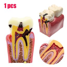 Autre hygiène bucco-dentaire 1 pièces modèle de dents dentaires 6 fois l'étude de comparaison des caries modèles de dents de prothèse Dentiste étudiant et recherchant le produit de dentisterie 230617