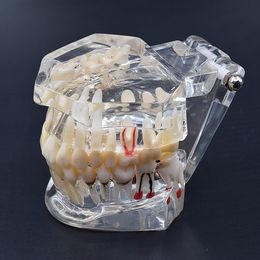 Autres accessoires dentaires d'hygiène bucco-dentaire modèle de dents de haute qualité étude d'enseignement des maladies des implants dentaires 230720